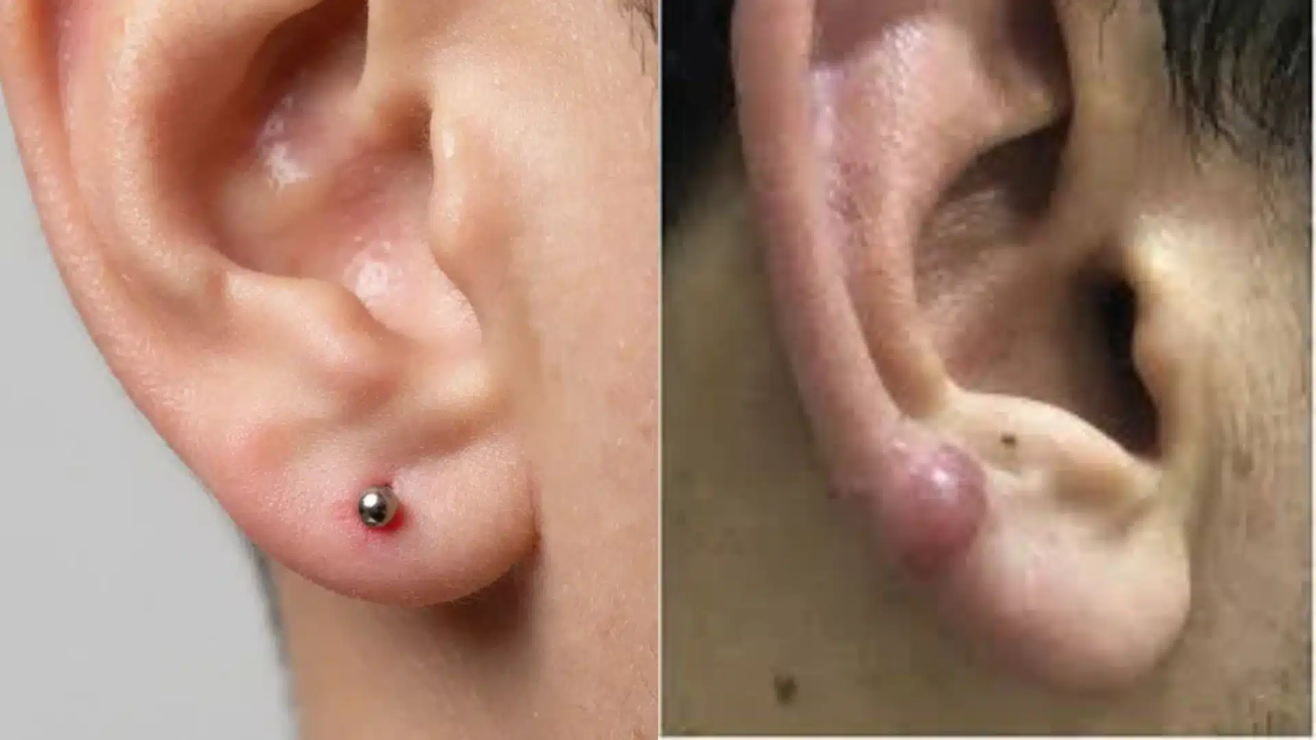 Split image shows an ear piercing bump on the left and a visible keloid on the right.
