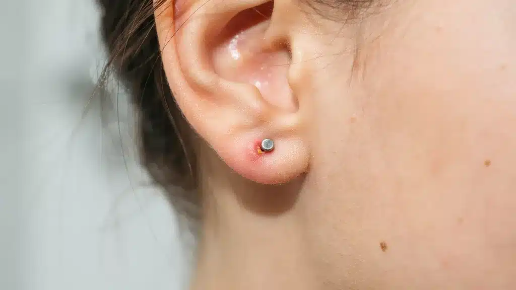 Close-up of an ear lobe with a stud earring and a small red irritated bump forming around the piercing site.