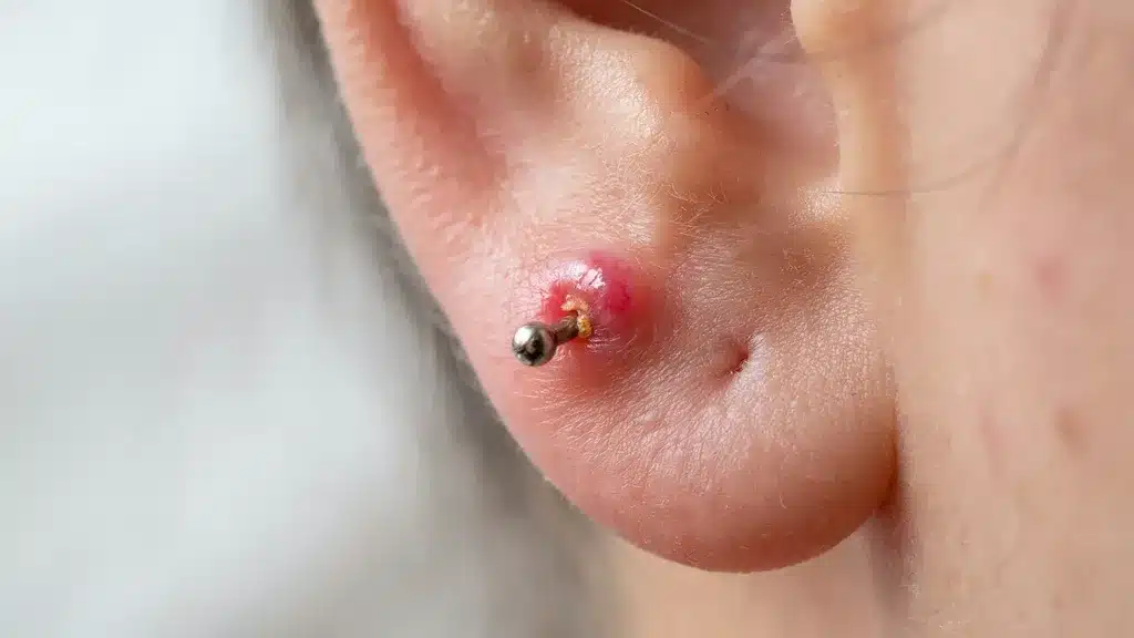 Close-up of an ear lobe with a metal stud piercing and a red, swollen irritation bump around the entry point.